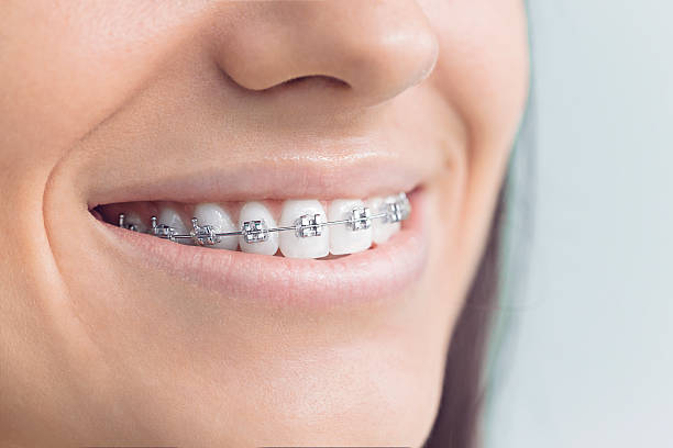 Best Veneers and Lumineers  in Wellsville, MO